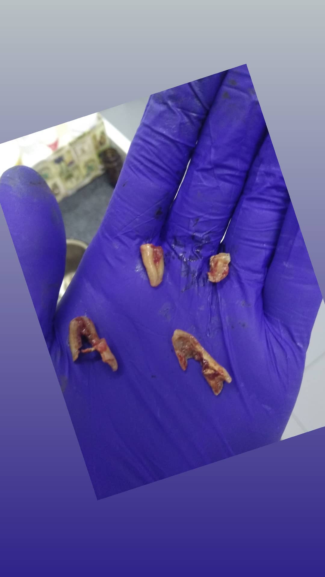 Лечение зубов любой сложности