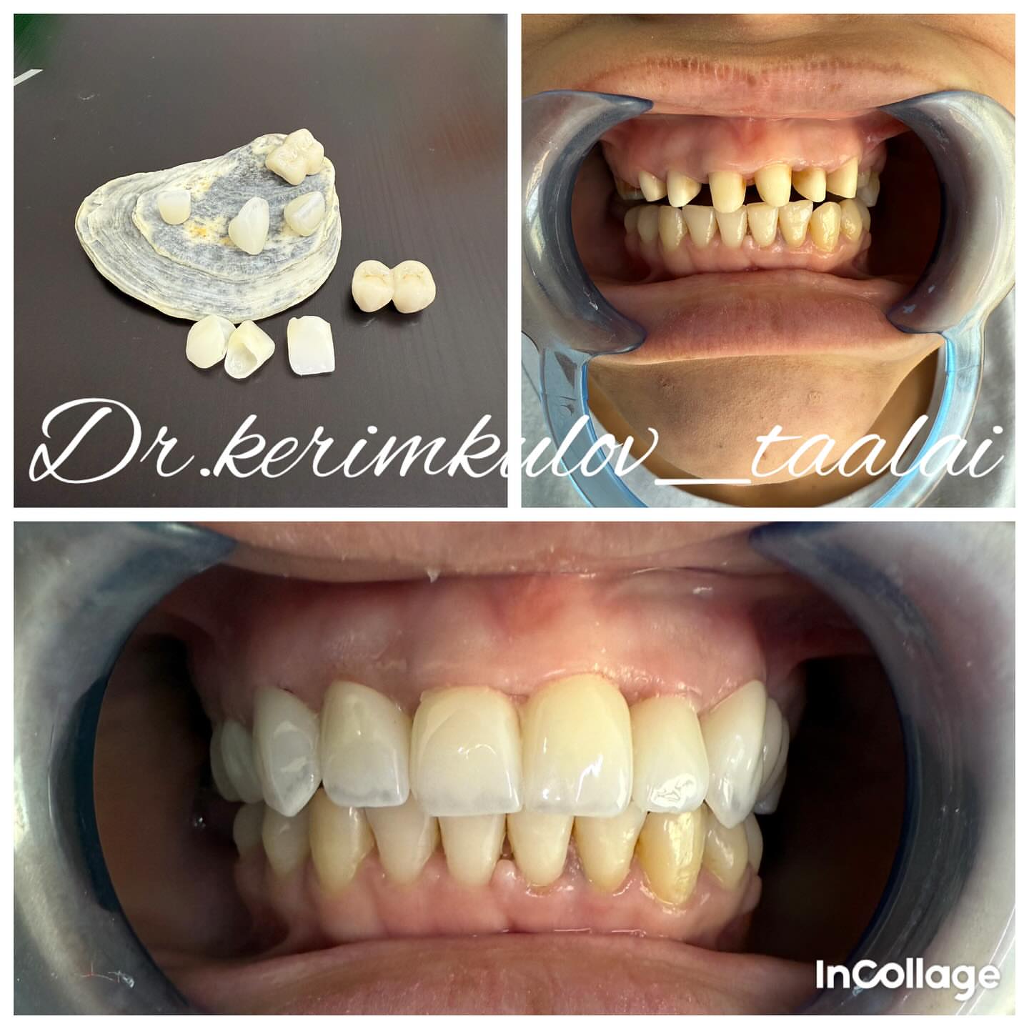 Коронки из диоксида циркония